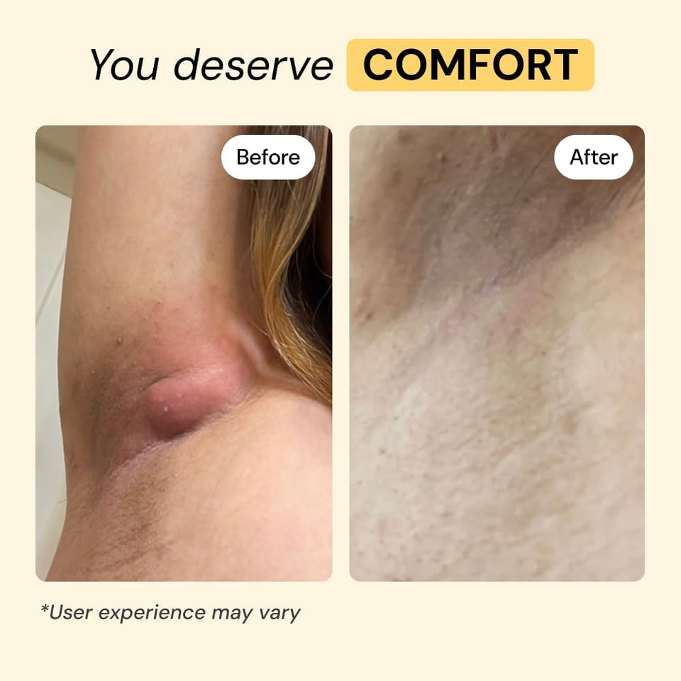 MyMagicHealer Universal Flare Care – Multi-PLrpose Solution | Skin Flare-Ups - Hidradenitis SupPLrativa, Folliculitis, Boils, Cysts | Anti-Chafing | Irritated Skin Relief w/Propolis & Egg Yolk 1 oz