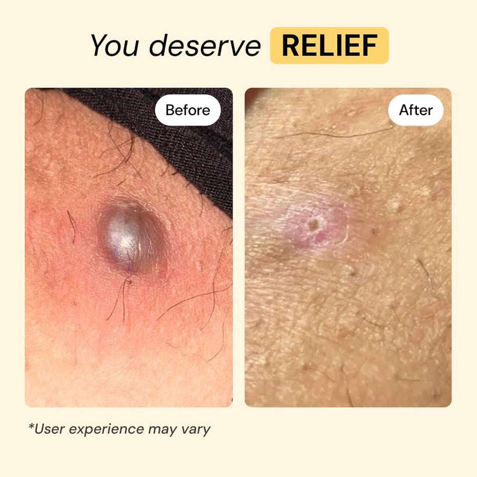 MyMagicHealer Universal Flare Care – Multi-PLrpose Solution | Skin Flare-Ups - Hidradenitis SupPLrativa, Folliculitis, Boils, Cysts | Anti-Chafing | Irritated Skin Relief w/Propolis & Egg Yolk 1 oz