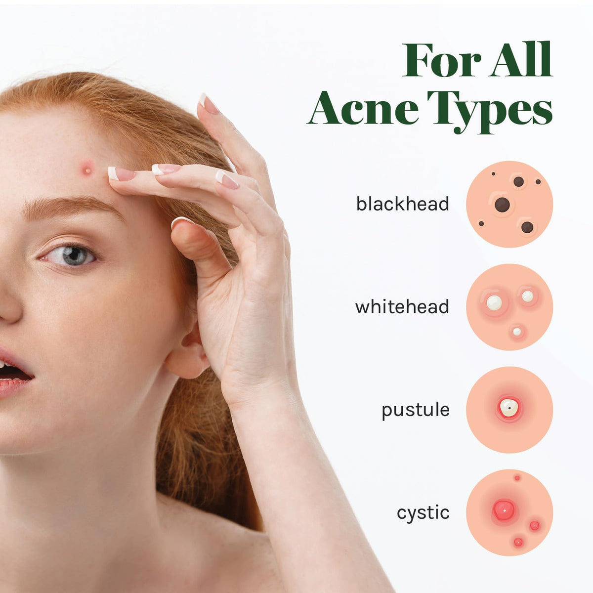AOA Studio 84-count Hydrocolloid Acne Patches, Vegan, Cruelty-Free, 10mm, 12mm Sizes, Spot Treatment for Blemishes and Acne