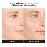 Paula's Choice BOOST 10% Azelaic Acid Booster Cream Gel Face Serum with Salicylic Acid, Oil-Free Skin Brightening Serum for Face, Fragrance-Free