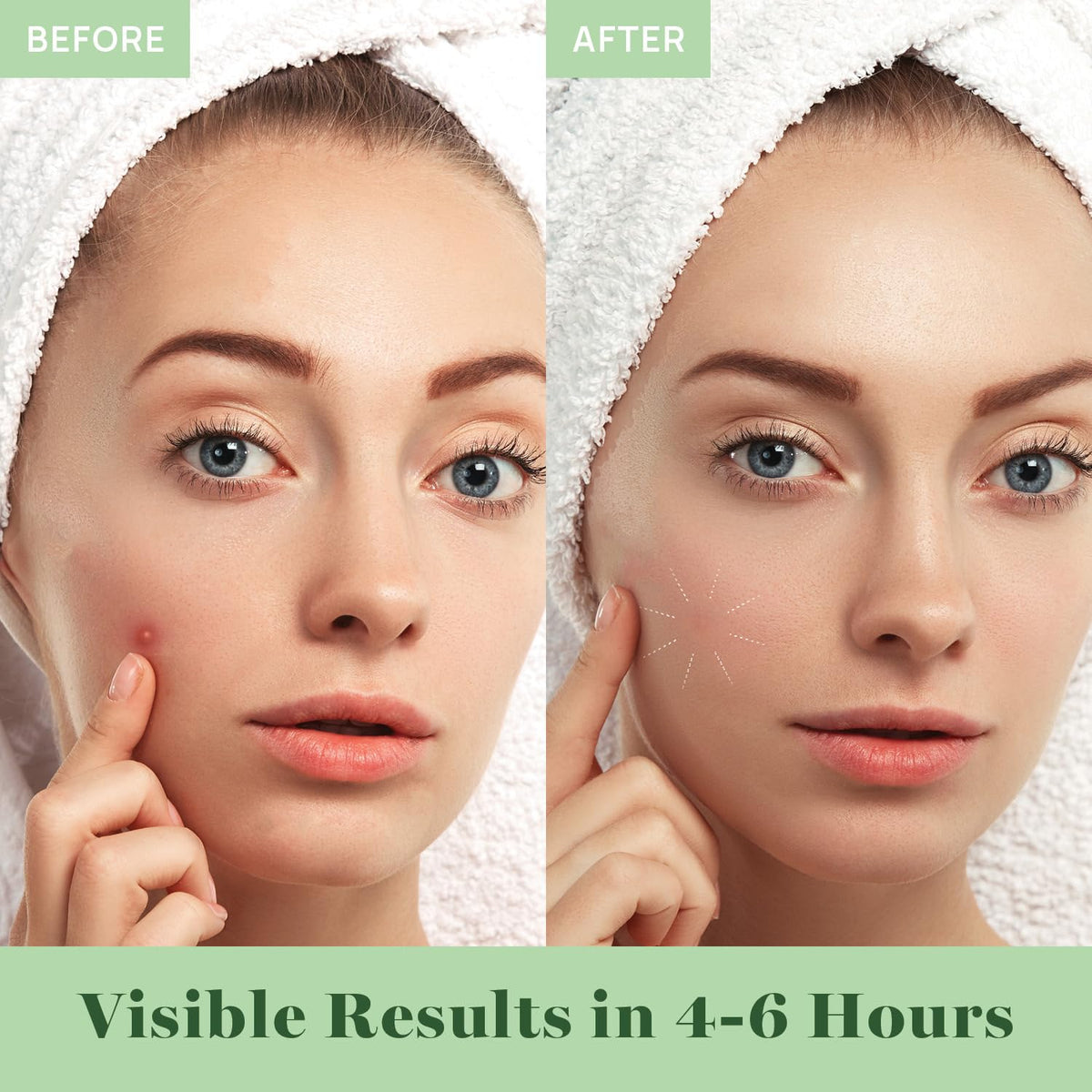 AOA Studio 84-count Hydrocolloid Acne Patches, Vegan, Cruelty-Free, 10mm, 12mm Sizes, Spot Treatment for Blemishes and Acne