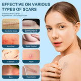Mitgary Advanced Scar Gel, Silicone Scar Gel, Treats Old and New Scars, Reduces the Appearance of Scars from, Body, Face, Stretch Marks, Surgical Scar, Keloids, Acne, Burns and More, 50g (1.7 Oz)