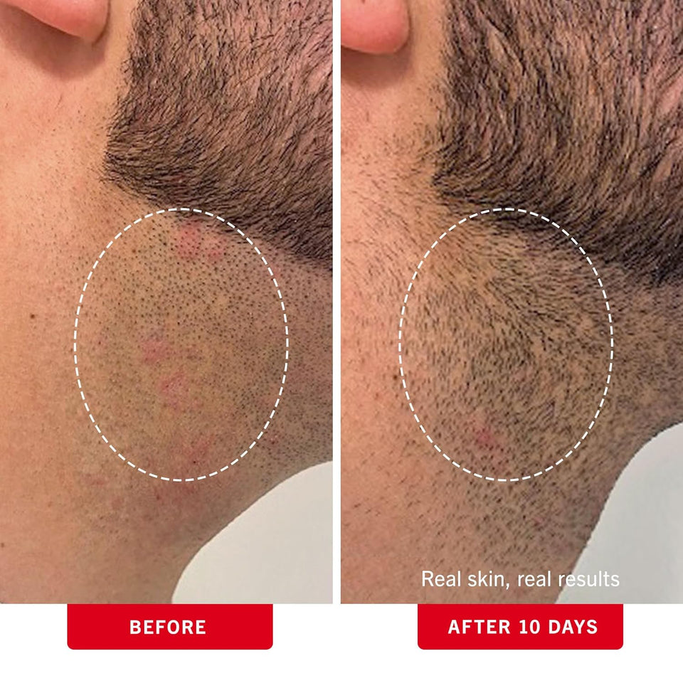First Aid Beauty - Ingrown Hair Pads with BHA + AHA - Aftershave Treatment Pads to Help Prevent Razor Bumps for Men & Women - Exfoliate Underarms & Bikini Area - Compostable for Daily Use - 28 Pads